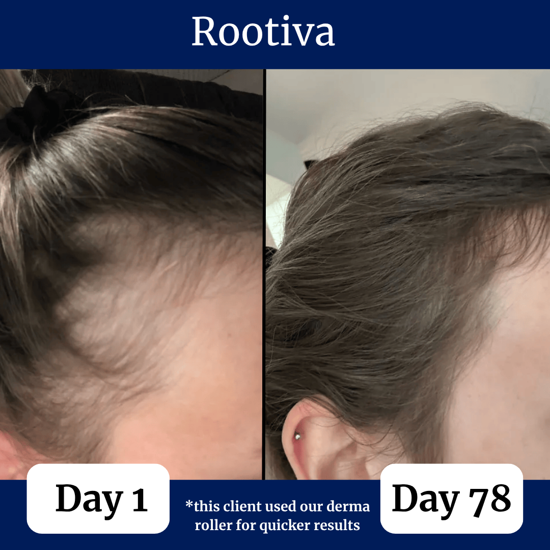 Rootiva Natural Roll On System