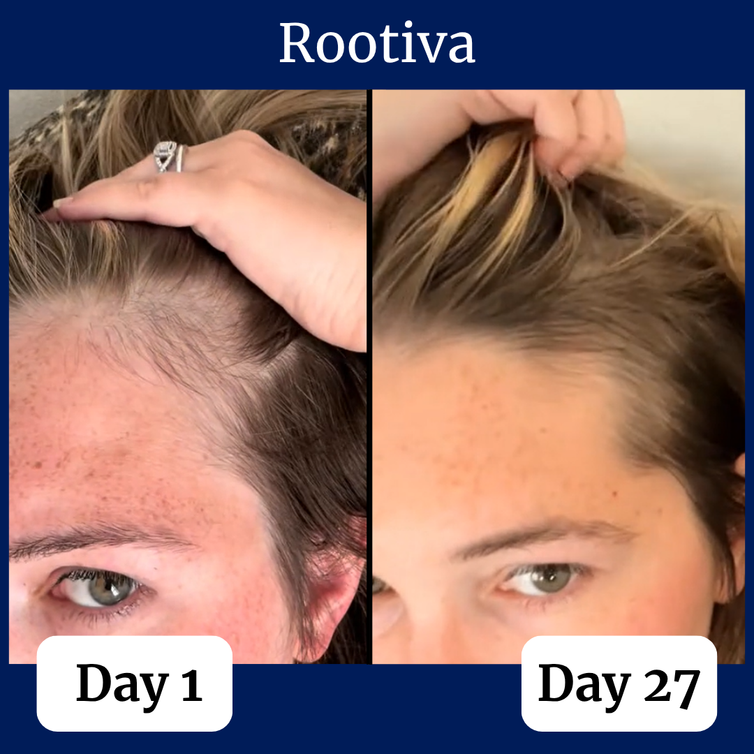 Rootiva Natural Roll On System