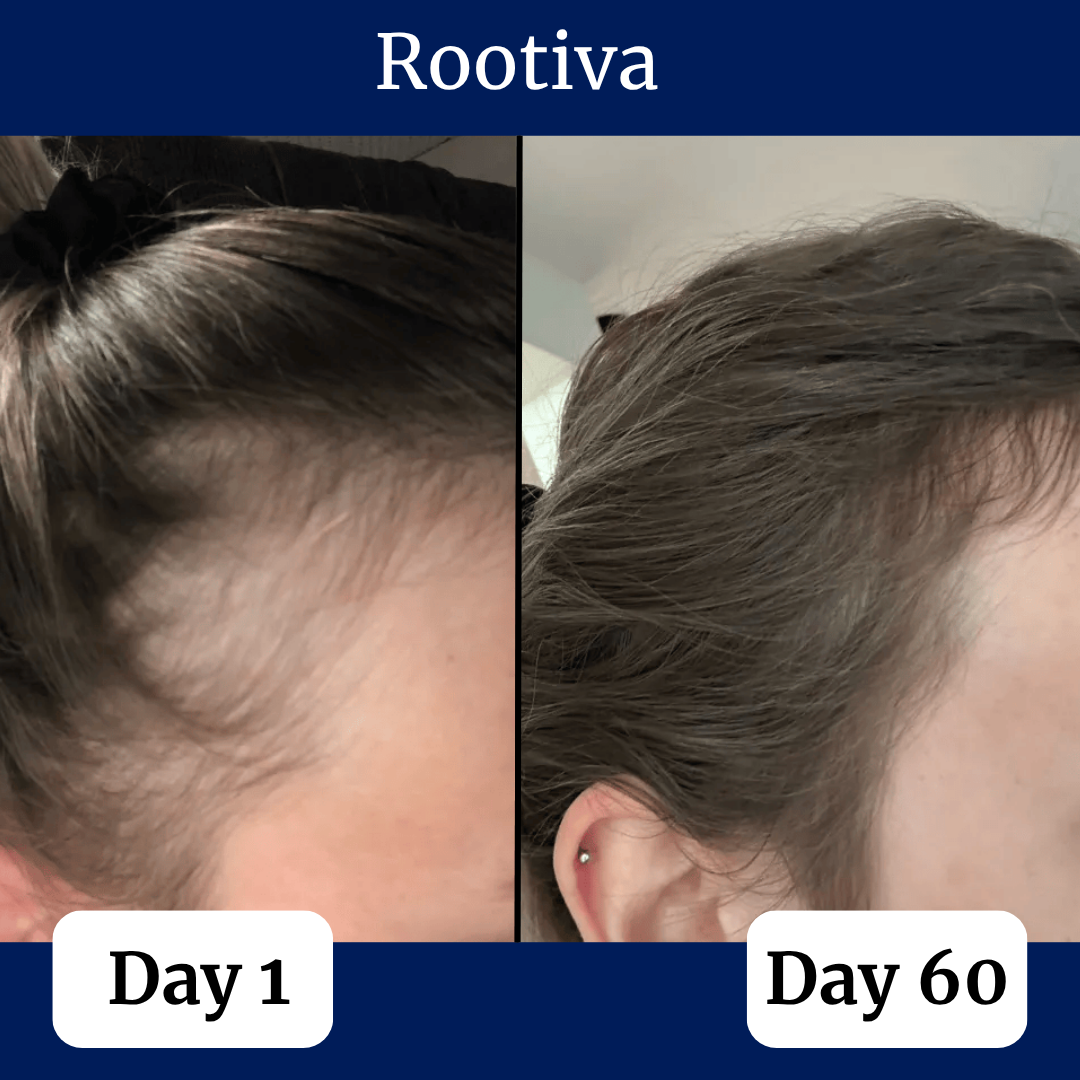 Rootiva Natural Roll On System